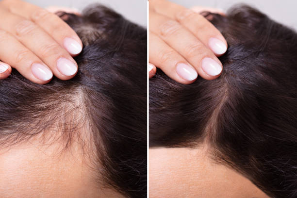 Woman Before After Hair Loss Treatment