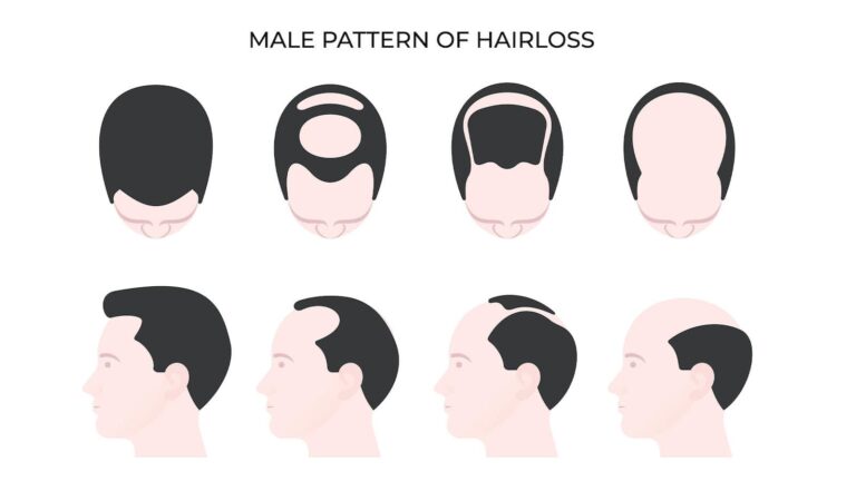 Male Pattern of Hairloss