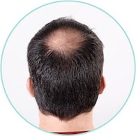 hair loss signs and symptoms 2