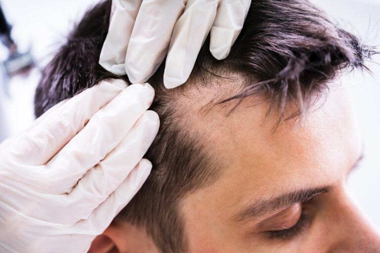 Male-pattern baldness is the most suitable candidate for hair transplantation
